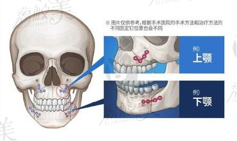 韩国id医院朴相薰院长直播，削骨手术后必须使用固定钉吗？