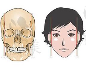 颧骨内推术后面部下垂怎么办?一定要找对原因和预防方法！