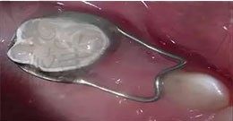 乳牙间隙保持器，拯救孩子乳牙早失的神器