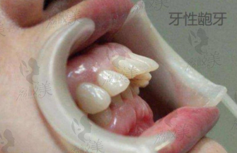 牙齿前突矫正牙齿能改变脸型听上海华美口腔安娟怎么说？