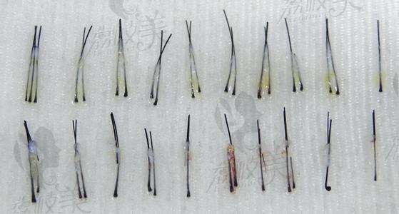 成都恒博种植发际线多少钱?植发1000单位毛囊的面积有多大?