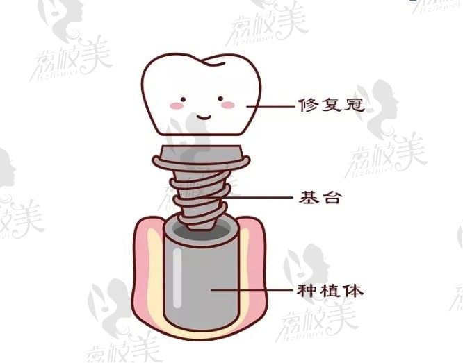 种植牙的过程是怎样的？兰州韩美齿科孙明福帮你解答
