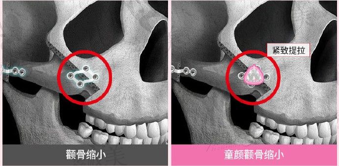 韓國id醫(yī)院樸相薰院長直播,顴骨顴弓手術(shù)后臉部會下垂嗎？