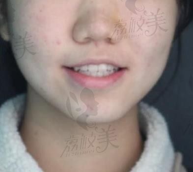  不拔牙可以做矫正吗?成都新桥口腔刘珊不拔牙矫正案例分享