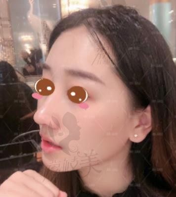 假体取出后鼻子会变形吗?深圳蒳美迩院长朱灿鼻修复怎么样?