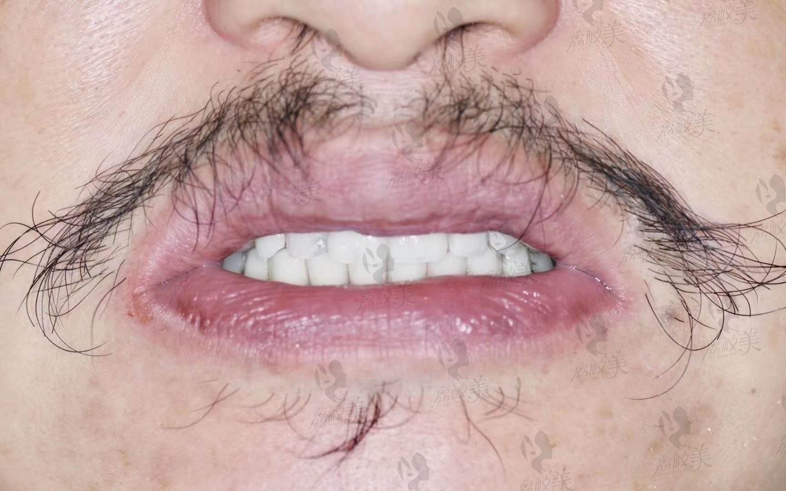 53岁大叔牙几乎掉光,在成都菁品口腔即刻种植恢复牙的经历