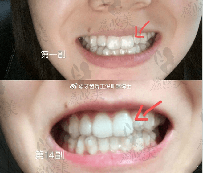 在深圳美莱口腔做韩旭正雅隐形矫正的14套牙套，太整齐了吧