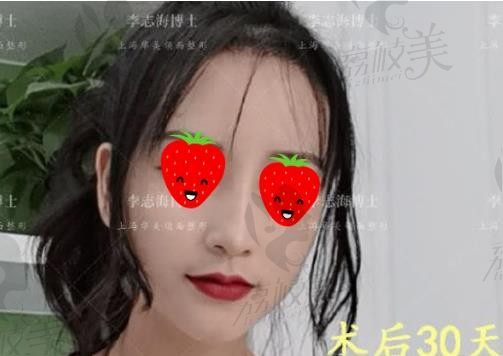 我在上海华美整形做了下颌角长曲线截骨,30天拥有精致下巴