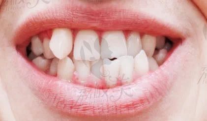 30岁+可以做牙齿矫正吗？北京佳美口腔王振华医生这样说