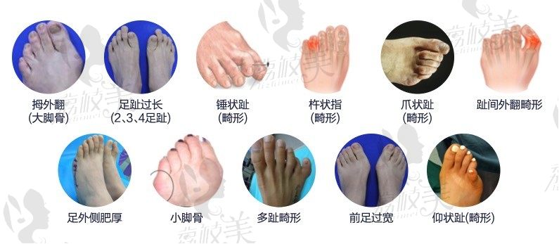 北京圣嘉新苏敬达专治拇外翻, 微孔祛大脚骨技术不反弹