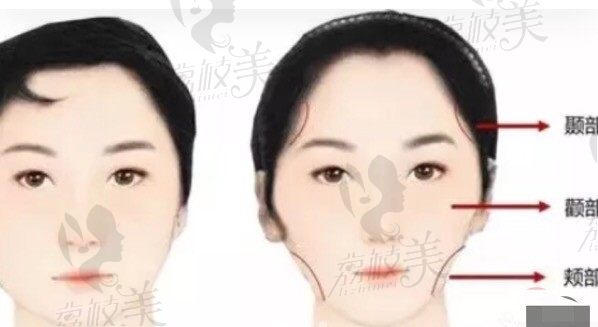 福州格莱美口腔王利勤解析矫正之后牙套脸出现以及避免。