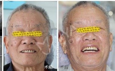 还在忍受假牙不便?老人在永州悦莱口腔5颗种植体恢复半口牙