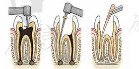 根管治疗去几次？西安海涛花3660还包括树脂补牙和全瓷牙冠