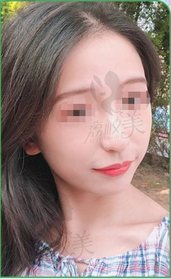 重庆赵亚均做全脸脂肪填充效果怎么样？附苹果肌案例对比