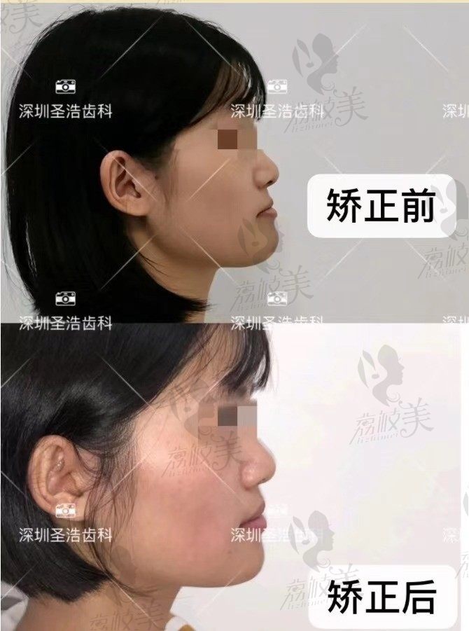 骨性（齿性）地包天如何矫正&深圳圣浩齿科反颌矫正上线
