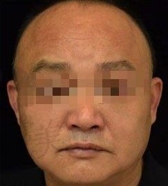 飞顿雷霆大Q祛斑效果好吗?--看黎京雄美肤治疗全过程案例图