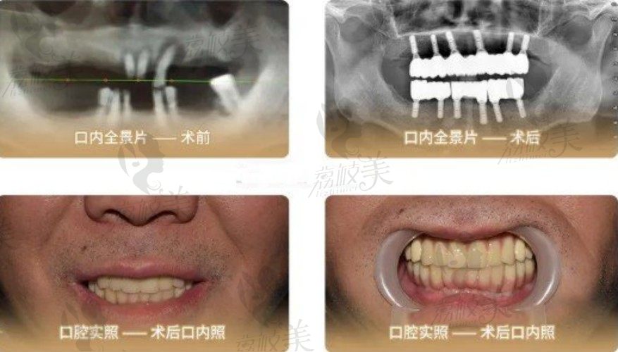 郑州美奥口腔医院是正规医院吗？刘兴国即刻种植技术好吗