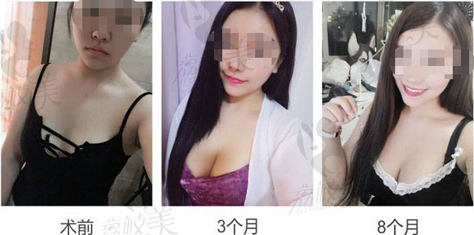 自体脂肪丰胸为什么会感染发炎？成都军大成应龙隆胸好吗