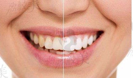 在南京月牙儿口腔做达妃琦蓝光美白牙齿,半小时色素牙变白