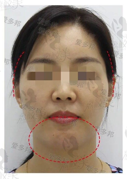 下巴注射生长因子3年后,找王绍国取出,看3个月后恢复效果图