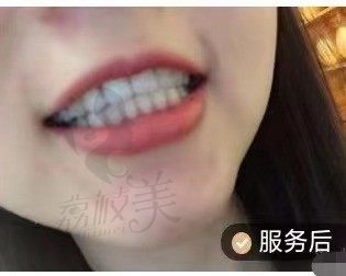 广州全家福李涛力口腔陶瓷半隐形矫正效果好不好？附案例