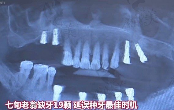 种植牙为啥比装假牙好？佳士洁口腔甘恒木医生案例来解答