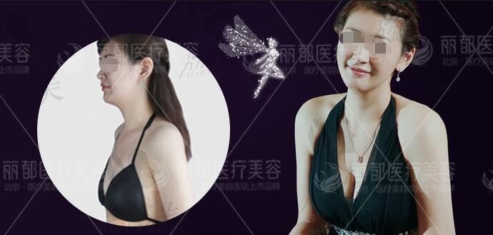 北京丽都高超医生内窥镜双平面丰胸手术过程可视,安全可靠!