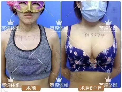 北京英煌梁耀婵院长瘦女人脂肪丰胸术-专做别人做不了的胸!