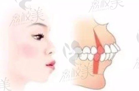父母龅牙会遗传给孩子吗？石家庄正畸医师崔立欣这样说