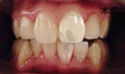 洗牙治牙痛,安徽太和李怀业孙迎迎PT3超声波洗牙案例分享
