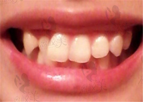 安徽阜阳壹加壹陶瓷隐形突嘴牙齿矫正技术提升了我的颜值