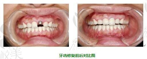 牙齿缺损？北京圣贝活动义齿.固定义齿.种植牙.修复选那种