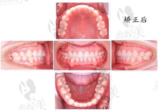 辉煌口腔牙列拥挤第二磨牙缺失,陶瓷隐形矫正牙齿案例分享