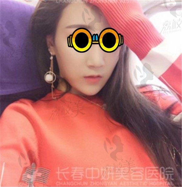 脸上痘印怎么办？长春中妍整形果酸焕肤案例分享