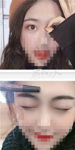 黑龙江超龙修复双眼皮不对称眼皮过宽肉条