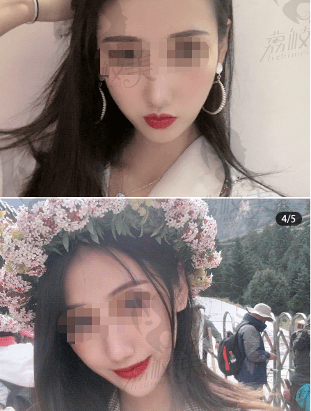 瘦脸针国产和进口哪个牌子好？打完皮肤下垂了怎么办？