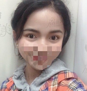苏州美莱赵春飞双眼皮术后1-30天,真人案例恢复效果怎么样？