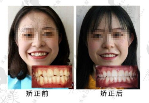 找水城口腔吴蕊医生做隐适美牙齿矫正，下巴后缩改善很多