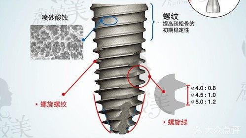 誰說骨質(zhì)差不能種植牙,天津麗德卡爾奧齒泰不植骨種植牙齒