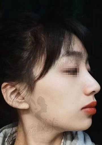 深圳丽雅口腔金属矫正怎么样，来看看患者小美的自述