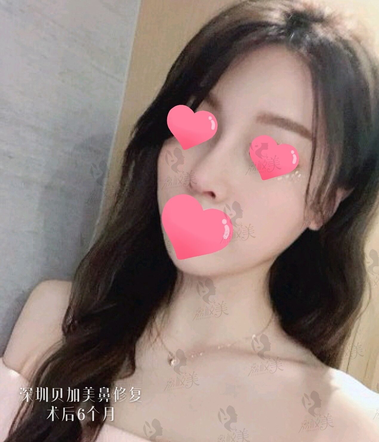 硅胶隆鼻会感染!深圳贝加美复杂鼻2次修复6个月后真实事件!