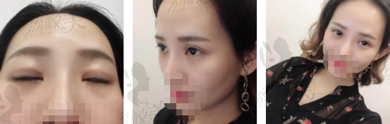 我在重庆华美做曹仁昌双眼皮修复假深宽30天变自然无痕！