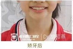 昆明柏得口腔青少年MRC肌功能矫正案例展示？效果怎么样