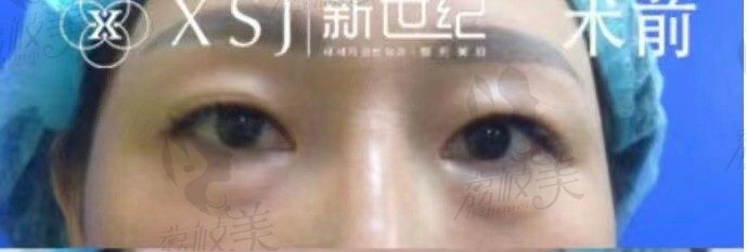 手术前