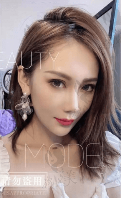 西安吉美赫拉耿向阳的双眼皮怎么样？术后效果好吗？
