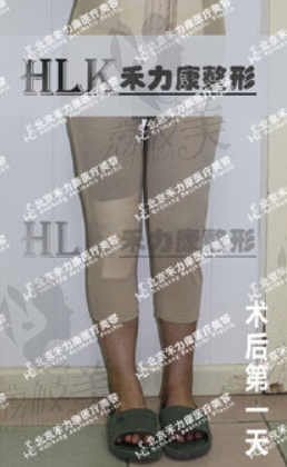 双腿粗细不一样咋办?北京禾力康腿不等粗美学矫正术后效果分享