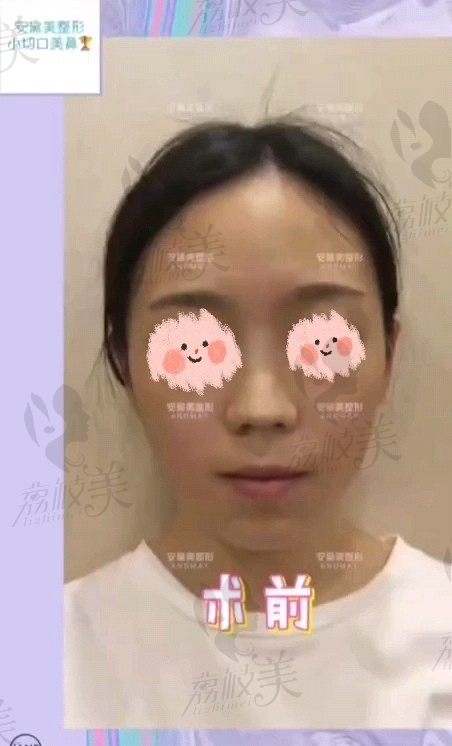 手术前