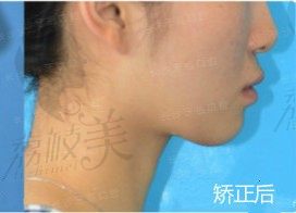 24岁小姐姐做自锁托槽矫正