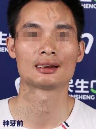 手术前