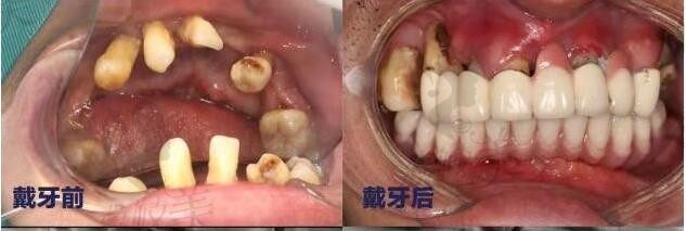 中山好民生口腔黎洪强ALL-ON-4半口种植案例当天解决牙齿缺失